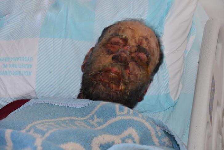 Pemfigus hastalığı 1 yılda yüzünü tanınmaz hale getirdi! 'Aynaya bakamıyorum' G3