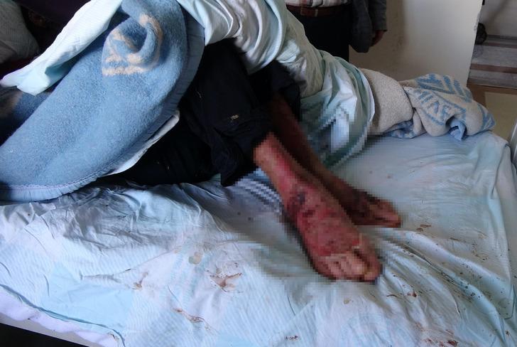 Pemfigus hastalığı 1 yılda yüzünü tanınmaz hale getirdi! 'Aynaya bakamıyorum' G5