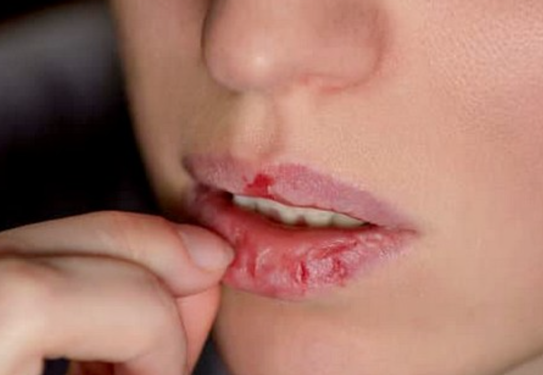 Kışın &ccedil;atlayan dudakların &ccedil;aresi evinizde! Dudakları neme doyuran doğal y&ouml;ntem