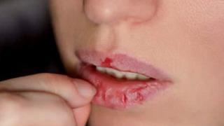 Kışın çatlayan dudakların çaresi evinizde! Dudakları neme doyuran doğal yöntem