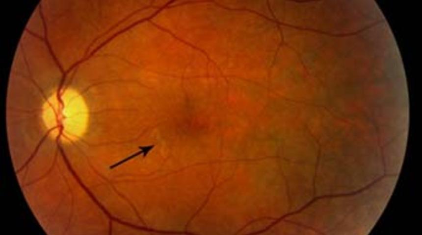 G&ouml;z&uuml;nden solucan &ccedil;ıktı!