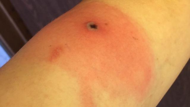 Yeni kabus: Alaskapox virüsü! Yetkililer ilk ölümün gerçekleştiğini duyurdu! İşte belirtiler...