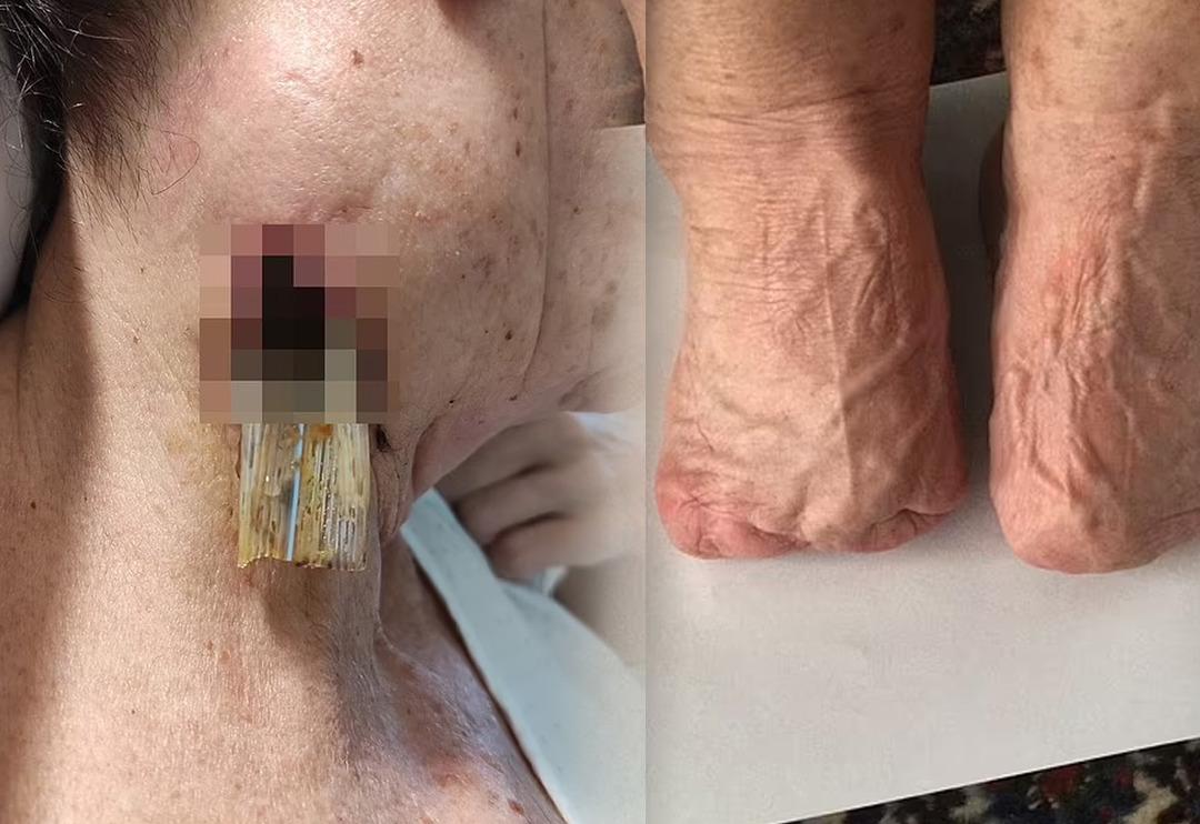 Doktorun verdiği ilacı i&ccedil;ti, derisi &ccedil;&uuml;r&uuml;d&uuml; ve parmakları kesildi! 40'tan fazla &uuml;lke o ilacı yasakladı