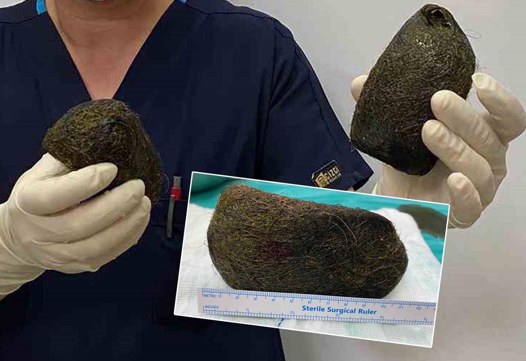 Bir insanın midesinden bu nasıl &ccedil;ıkar... Taş gibi g&ouml;r&uuml;n&uuml;yor ama değil! Tam 2 kilo