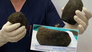 Bir insanın midesinden bu nasıl çıkar... Taş gibi görünüyor ama değil! Tam 2 kilo