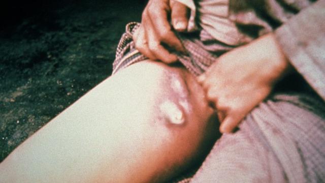 'Kara Ölüm' olarak da biliniyor! En son 2015'te görülmüştü... Yıllar sonra ilk vaka ortaya çıktı