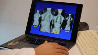 Skolyoz hastası çocuklar için umut olan tedavi! 'Devrim niteliğinde' diyerek anlattı