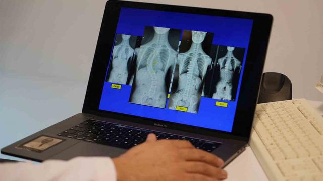 Skolyoz hastası çocuklar için umut olan tedavi! 'Devrim niteliğinde' diyerek anlattı