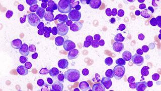 Sinsi kanser: Multipl Miyelom