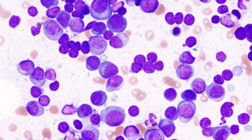 Sinsi kanser: Multipl Miyelom