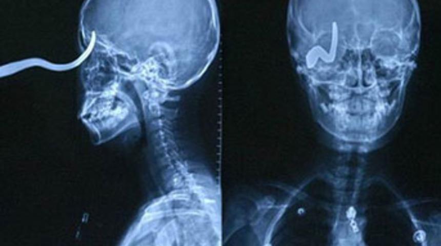 Ölümden 2 milimetre ile kurtuldu!