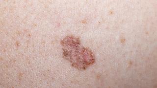 Dünyada bir ilk! Cilt kanseri için çığır açacak tedavi yöntemi onaylandı: Hasta başı 515 bin dolar