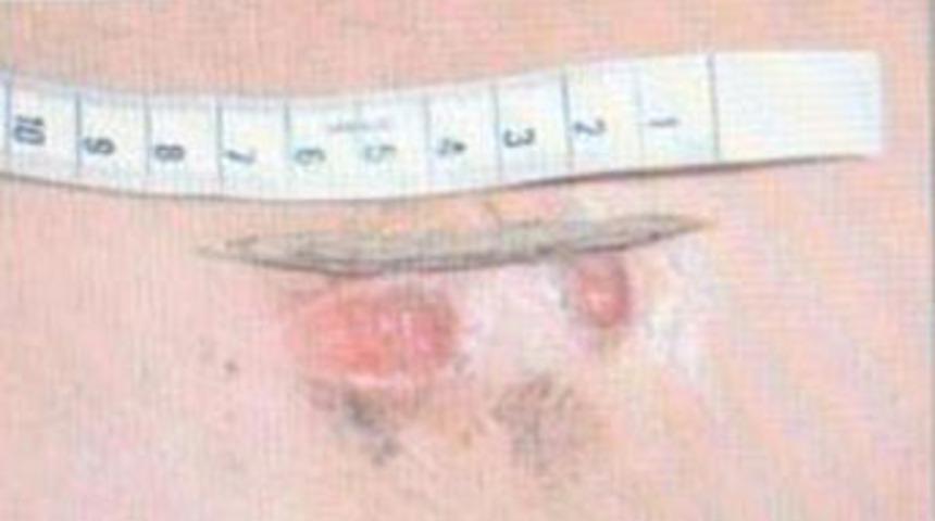 Tıp dünyası şokta, yuttuğu ot sırtından çıktı