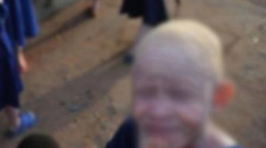 İksir i&ccedil;in albino &ccedil;ocuğu par&ccedil;aladılar