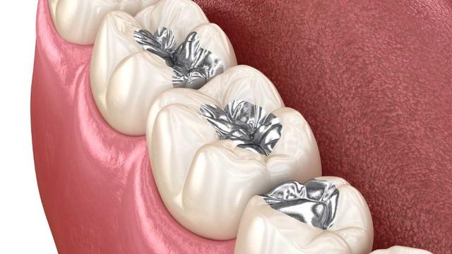 Dolgularda cıva tehlikesi! Zehirleyerek yıllarca; kronik yorgunluk, depresyon, uykusuzluk ve sindirim sorunlarına yol açıyor