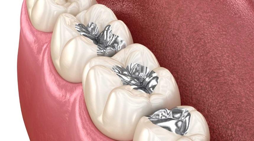 Dolgularda cıva tehlikesi! Zehirleyerek yıllarca; kronik yorgunluk, depresyon, uykusuzluk ve sindirim sorunlarına yol açıyor