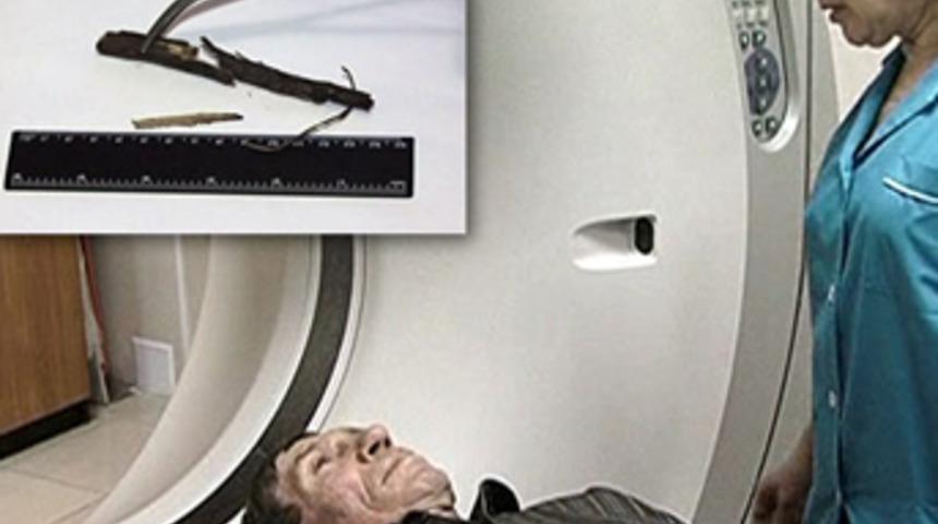 6 ay boyunca kafasında 13 cm odun ile dolaştı