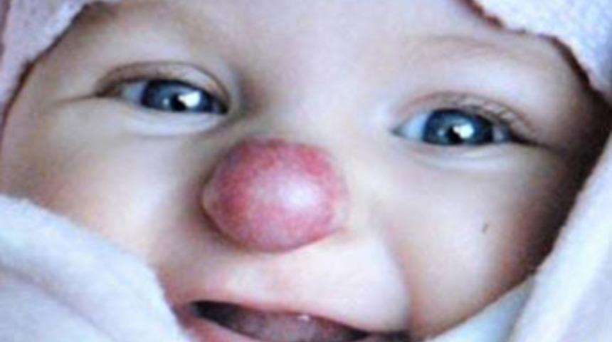 Doğuştan palya&ccedil;o