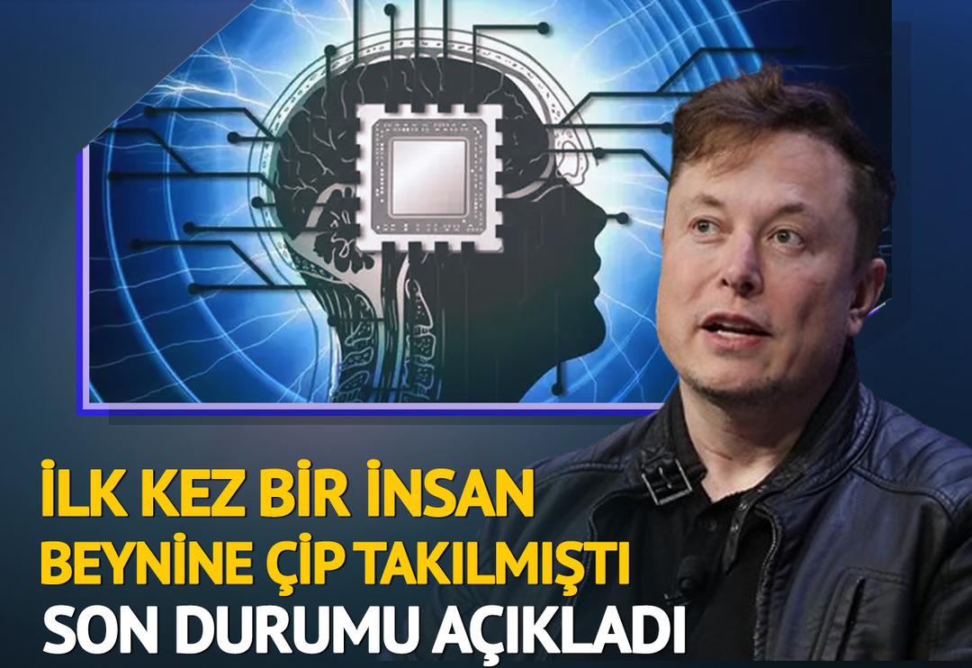İlk kez insan beynine &ccedil;ip takılmıştı! T&uuml;m d&uuml;nya hayrete d&uuml;şecek... Herkes merak ediyordu, Elon Musk: "Sadece d&uuml;ş&uuml;nerek hareket ettirebiliyor"
