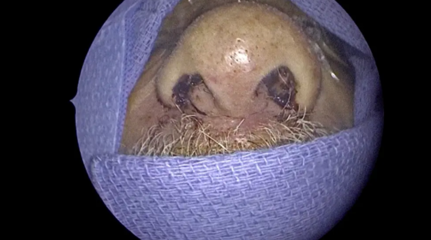 Doktorları şaşkına çeviren vaka: Burnundan 150 canlı solucan çıkartıldı! "Orada olduklarını bile bilmiyordum"