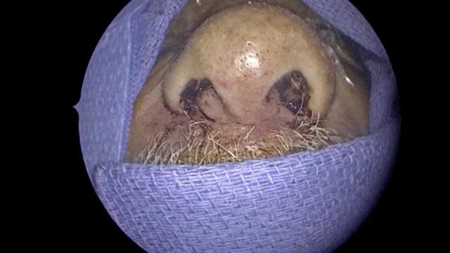 Doktorları şaşkına çeviren vaka: Burnundan 150 canlı solucan çıkartıldı! Orada olduklarını bile bilmiyordum