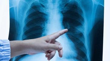 Akla gelen ilk tür: Akciğer kanseri... Tek suçlusu sigara mı?