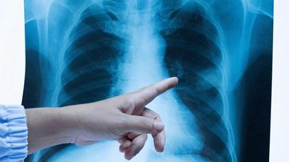 Akla gelen ilk tür: Akciğer kanseri... Tek suçlusu sigara mı?