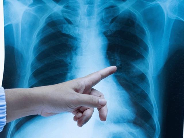 Akla gelen ilk tür: Akciğer kanseri... Tek suçlusu sigara mı?