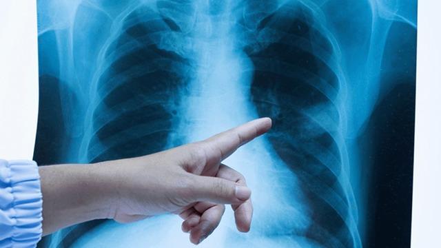 Akla gelen ilk tür: Akciğer kanseri... Tek suçlusu sigara mı?