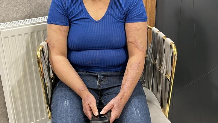 Her kelimesi insanlık dışı: Bacağına sıcak ütü bastılar, kolonya döküp canlı canlı yakmak istediler G5