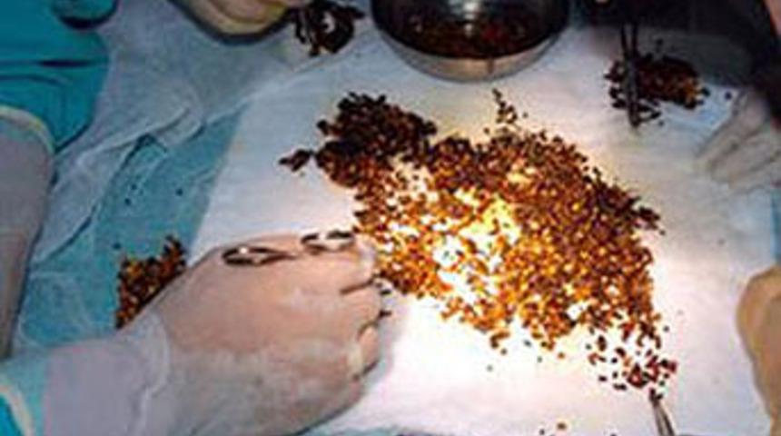 Hepsi safra kesesinden çıktı