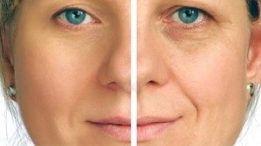 Sivilce Problemi Artık Tarih Oldu