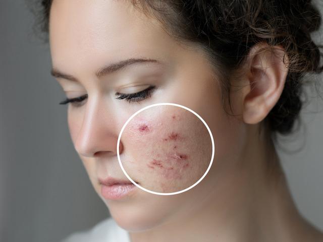 Yetişkinler akne sorunuyla karşı karşıya: Makyaj, hormonlar ve beslenme akne alarmı veriyor