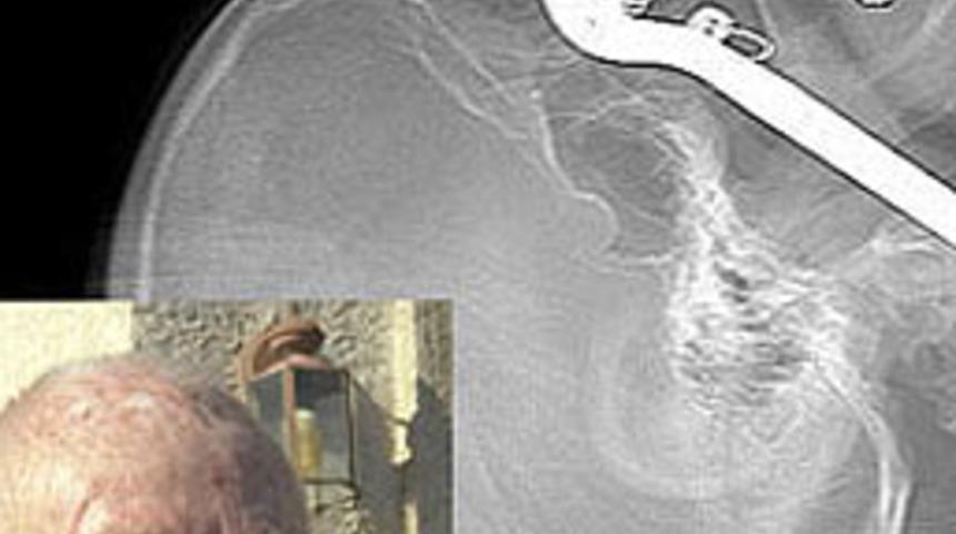 G&ouml;z&uuml;nden boğazına kadar girdi