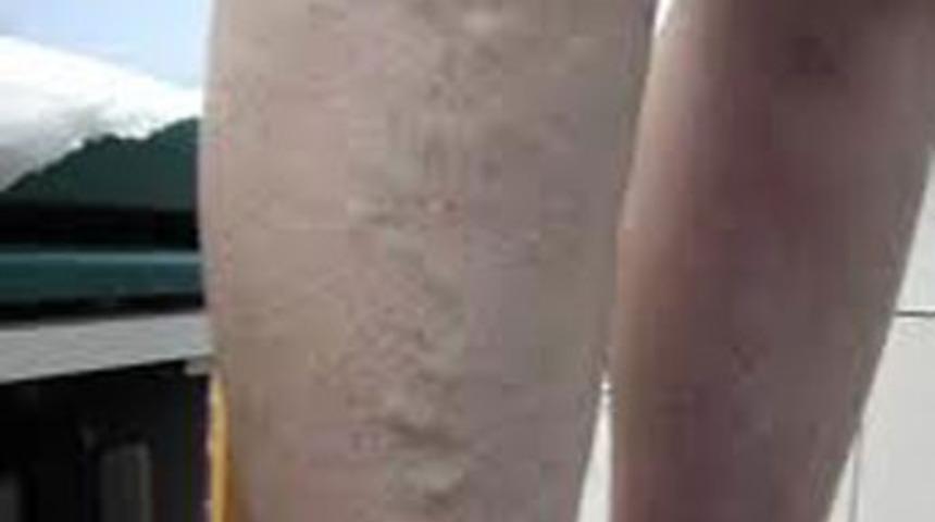 Lazer'le Varis tedavisi nasıl olur?