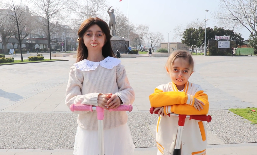 Biri 10 diğeri 13 yaşında! 8 milyonda bir g&ouml;r&uuml;len yaşlanma hastalığına yakalandılar: Hayalleri yıldız futbolcuyla bir araya gelmek