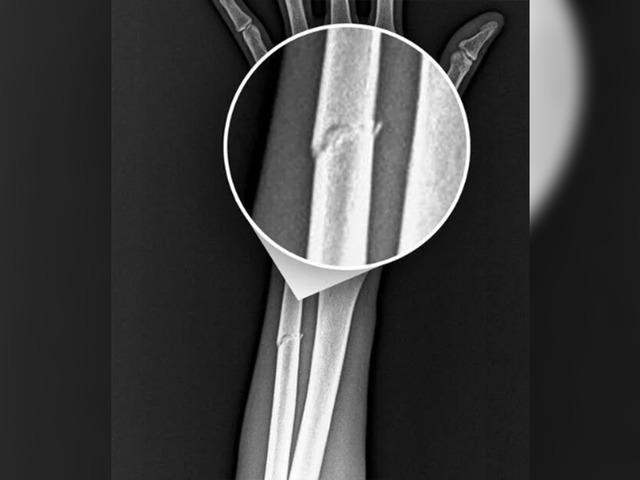 Trabzonspor kötü haberi resmen açıkladı! Onuachu'nun kolunda kırık tespit edildi