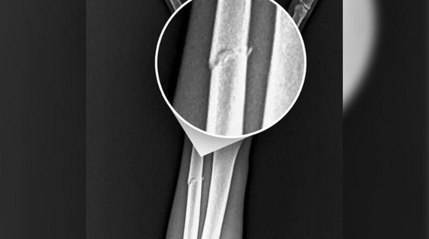 Trabzonspor kötü haberi resmen açıkladı! Onuachu'nun kolunda kırık tespit edildi