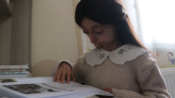 Biri 10 diğeri 13 yaşında! 8 milyonda bir görülen yaşlanma hastalığına yakalandılar: Hayalleri yıldız futbolcuyla bir araya gelmek G1