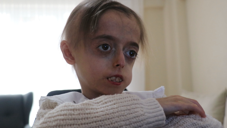 Biri 10 diğeri 13 yaşında! 8 milyonda bir görülen yaşlanma hastalığına yakalandılar: Hayalleri yıldız futbolcuyla bir araya gelmek G2