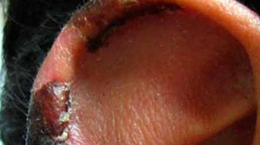 "Et yiyen" salgın dehşeti!