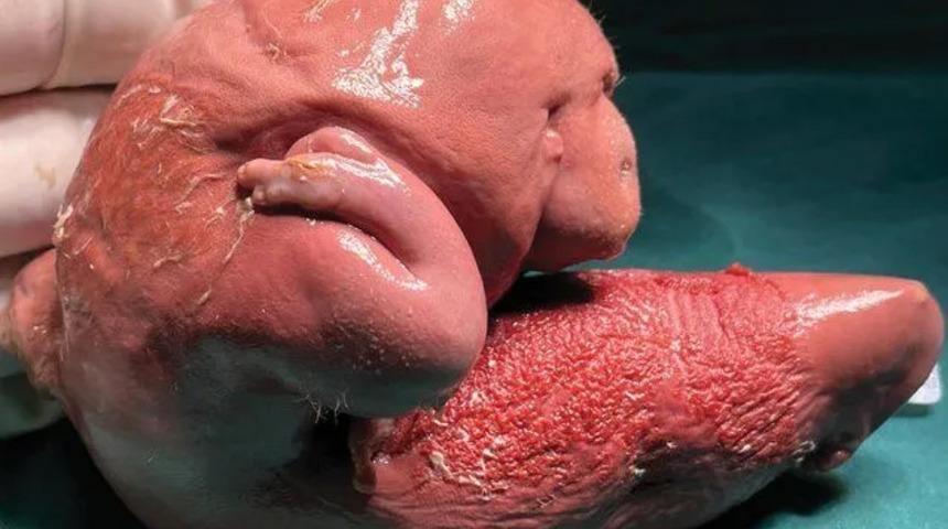 1 yaşındaki bebek kafası geniş olduğu için hastaneye getirildi: İnanılmaz gerçek ortaya çıktı! İkizi beyninin içindeymiş...