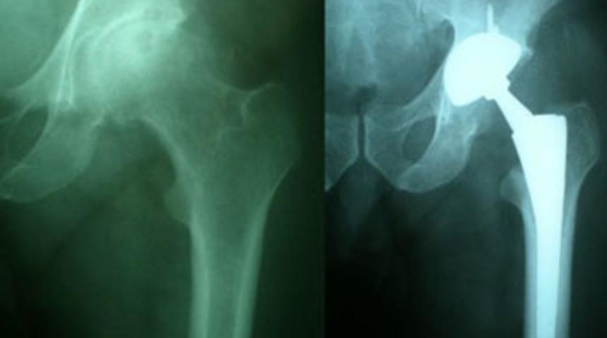 Kalça protezi skandalı