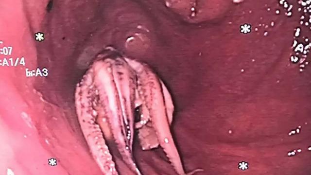 Yemek yedikten sonra birden rahatsızlandı... Doktorlar gördükleri karşısında şaşkına döndü: Tam 5 santimetre!