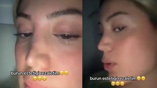 Estetik ameliyattan sonra burnunun yeni görüntüsünü paylaştı! Bir gören bir daha baktı... Burun estetiği rezaletim