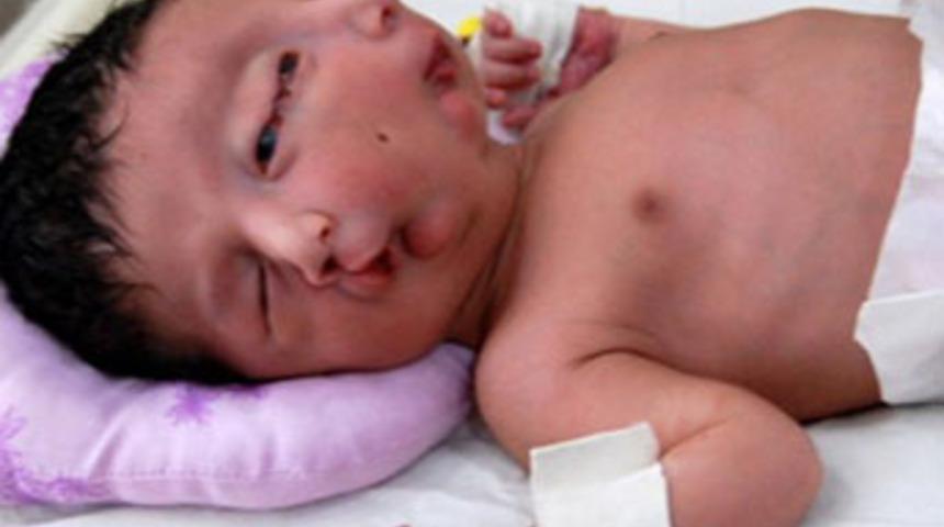 İki yüzlü bebek şaşırttı