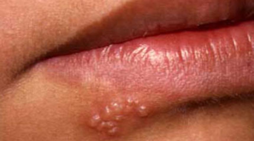 Uçuklarda gizli tehlikeye dikkat