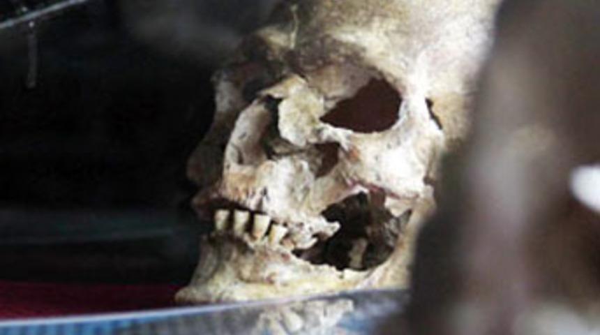 4500 yıllık beyin ameliyatı