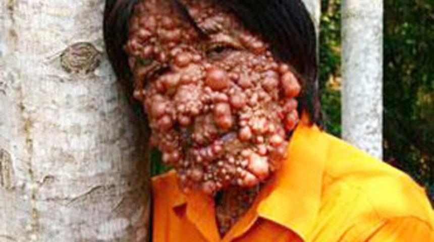 'Balon adam'ın dramı