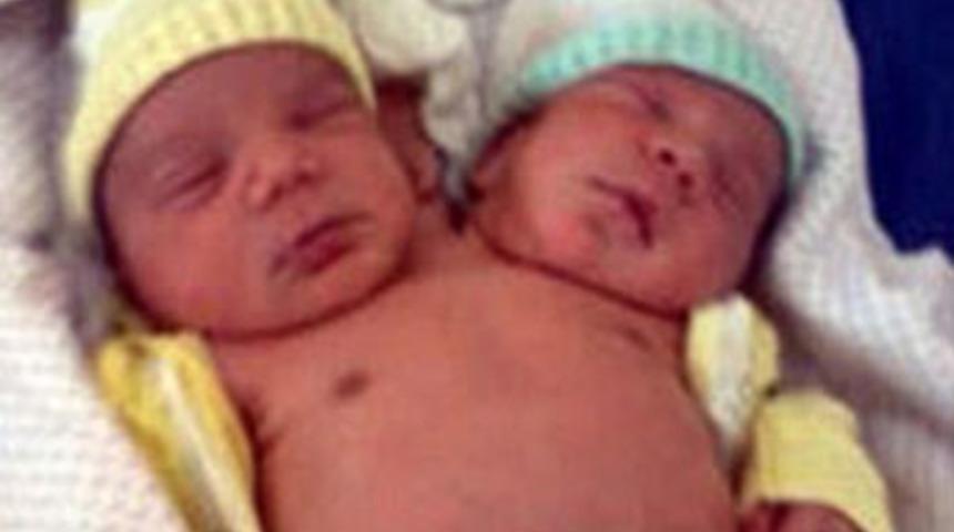 &Ccedil;ift başlı bebek şaşırtıyor